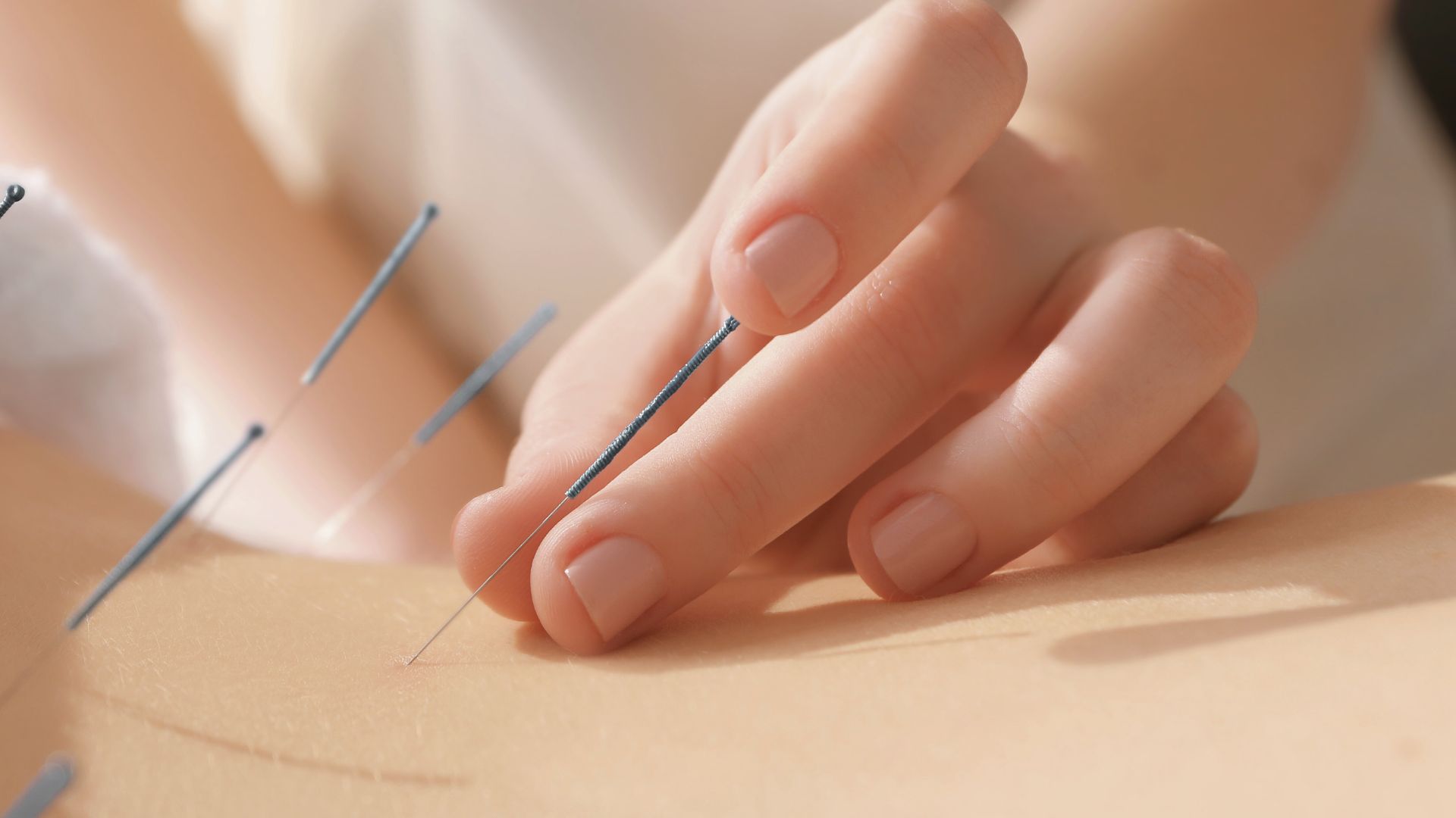 acupuntura